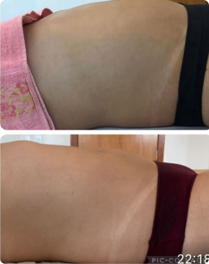 ANTES E DEPOIS